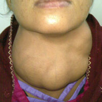 thyroid-disease